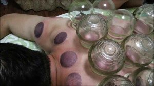 ventosaterapia-cupping-pseudomedicina-tradicional-china